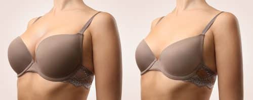 My Favourite Compression Bra After Breast Explant Surgery