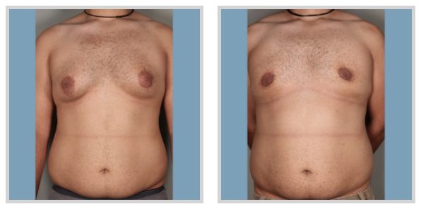 Male breast lift surgery reverses changes after large weight loss, Health