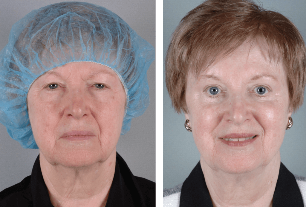 eyelid-surgery-for-droopy-eyelids-north-shore-aesthetics