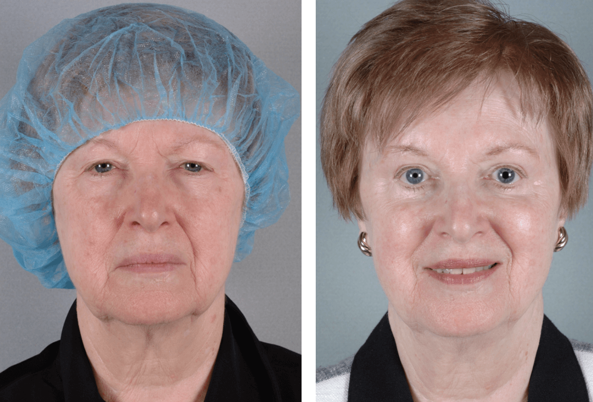 Upper Blepharoplasty Before And After Photo 