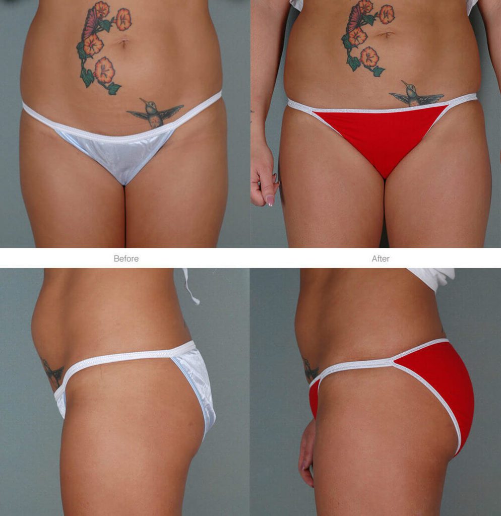 Brazilian Butt Lift Surgery: Before and After Pictures