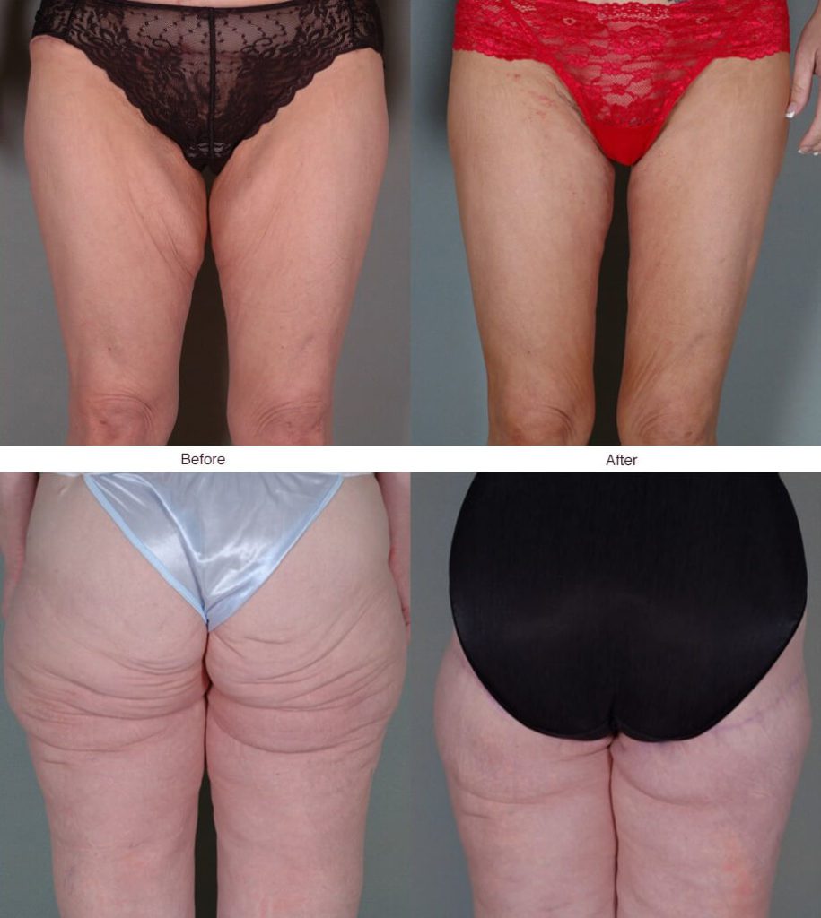 Thigh Miami - Drainless Thigh Lift - Inner Thigh Fat Removal