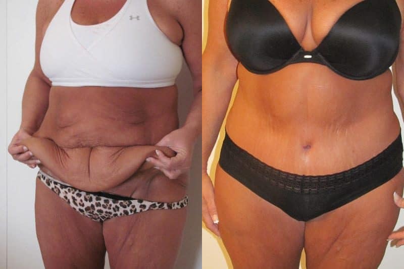 Post Weight Loss Surgery, Chicago, IL