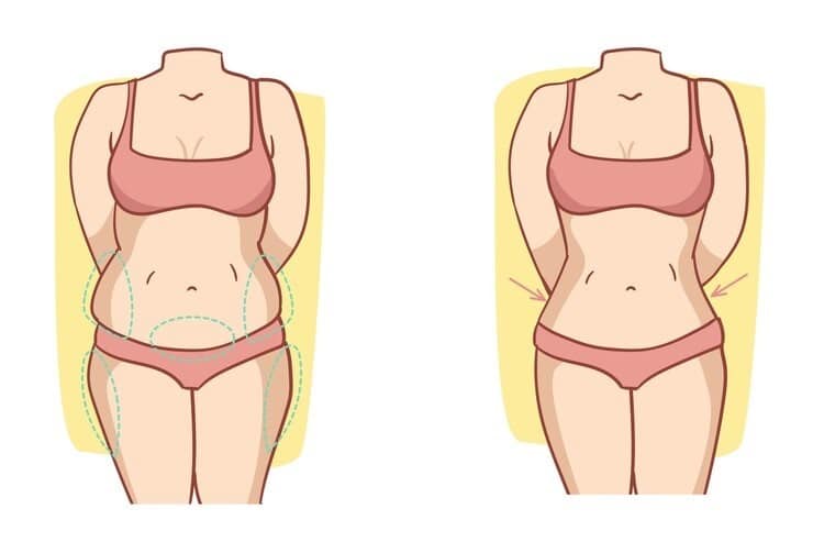 scarless tummy tuck before and after